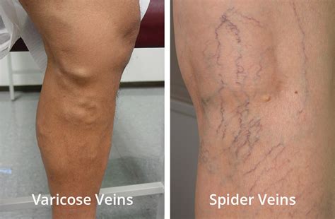 Spidervaricose Veins Now You See Them Now You Dont Pine Belt