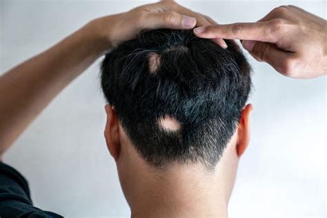 What Causes Hair Loss And How To Prevent It