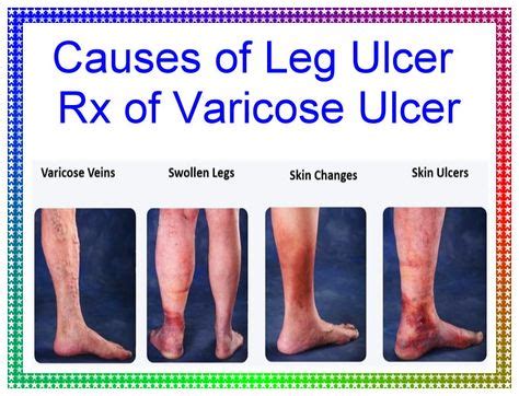 Causes Of Leg Ulcer Rx Of Varicose Ulcer In Leg Ulcers Varicose Ulcer Ulcers
