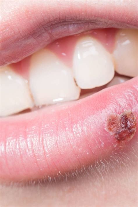 Why Do I Keep Getting Cold Sores Causes And Prevention