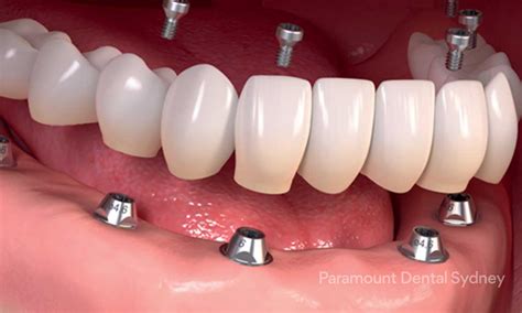 Full Mouth Dental Implants Paramount Dental Sydney Cbd — Paramount