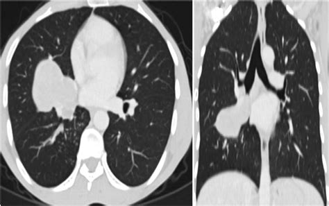 Chest Ct Scan Showing Enhancing Lobulated Right Lung Middle Lobe Soft