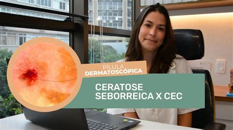 PÍlula DermatoscÓpica 59 Ceratose Seborreica Irritada X Cec Youtube