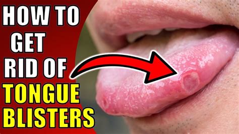 how to get rid of tongue blisters canker sores top ten remedies for tongue ulcers youtube