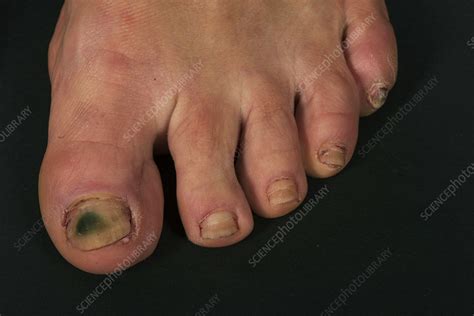 Fungal Nail Infection Stock Image C0494383 Science Photo Library