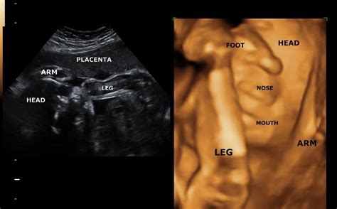 30 Week 3d Ultrasound Images 3d Ultrasound Ultrasound Placenta