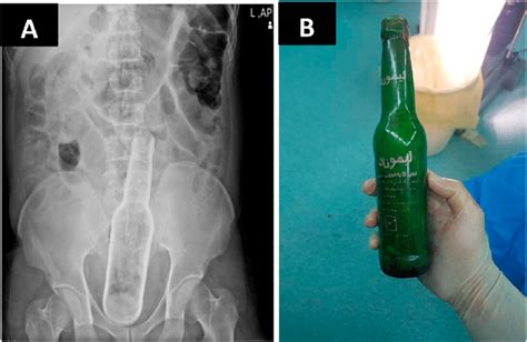 The Images Show A Foreign Body In Rectum And B The Glass Bottle Download Scientific