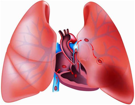 Embolia Pulmonar Defini O Causas Sintomas Diagn Stico Tratamento