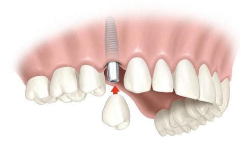 Implantes Dentales Con Carga Inmediata