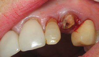 Loose teeth are concerning, but rarely a cause for panic. Broken Tooth ~ Extraction ~ OCO Dental Implant Procedure ...