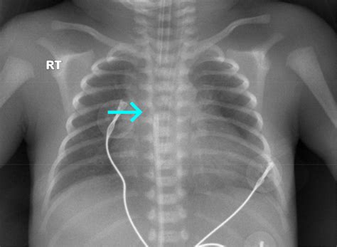 Chest Radiography Shows The Tip Of The Umbilical Venous Catheter In The