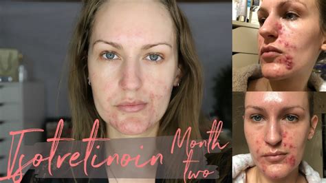Isotretinoin Diaries Month 2 Insane Improvements Youtube