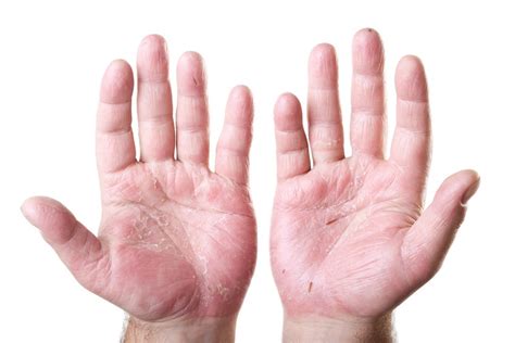 Hand Eczema Causes Symptoms And Treatment Options