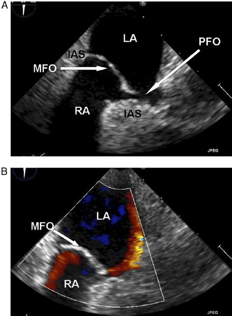 Apical Four Chamber View Of Transthoracic Echocardiogram After Pfo