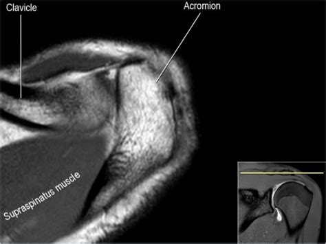 Mri Musculo Skeletal Section Mri Anatomy Of The Shoulder Axial View