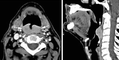 Figure 4 Contrast Enhanced Ct Images In A Patient With Cancer Of The