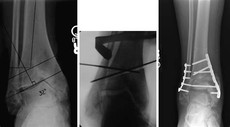 Supramalleolar Osteotomy Clinics In Podiatric Medicine And Surgery