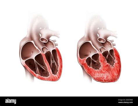 Corazón Normal Y Ampliado Ilustraciones De Corte Normal Izquierda Y