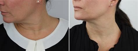 Neck And Jawline Programme Clinicbe London Belgravia