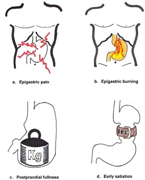 Dyspepsia And Gastroparesis About Irritable Bowel Syndrome