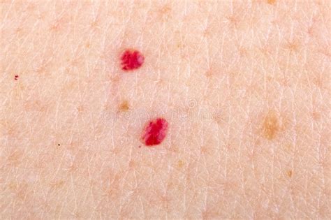 Cherry Angioma On Human Skin Stock Photo Image Of Patch Melanoma