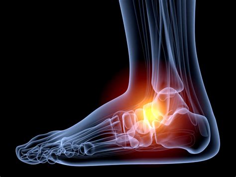 Most people who think of a sports medicine physician think that they. Causes of Ankle Sprains - Premier Orthopedic Surgeon ...