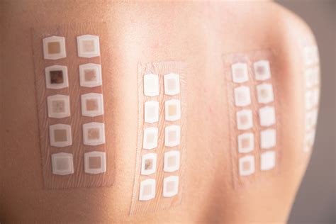 Skin Allergy Test Procedure Types Results And Cost