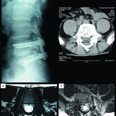 A B The Ct And Mri Of Pre Op Showed The Lumbar Disc Herniation
