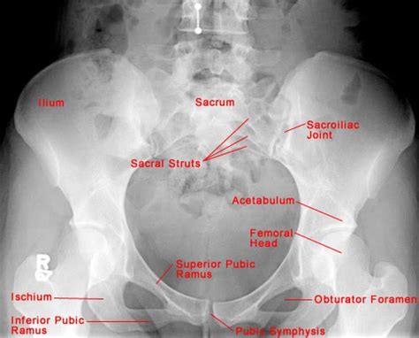 Basic X Ray Normal Pelvic Anatomy