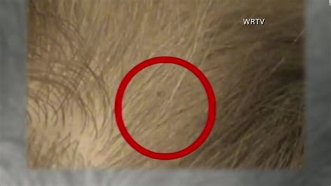 What Is Super Lice And How Can You Treat It Cnn Video
