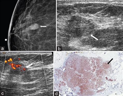 Rare Malignant Tumors Of The Breast Journal Of Clinical Imaging Science