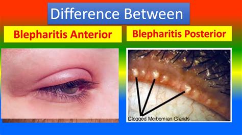Difference Between Blepharitis Anterior And Blepharitis Posterior Youtube