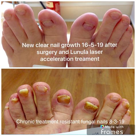 New Fungal Nail Treatments 2019 A Tailored Treatment Approach