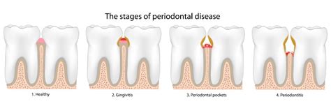 The 4 Stages Of Gum Disease Hillstream Dental Rochester Hills