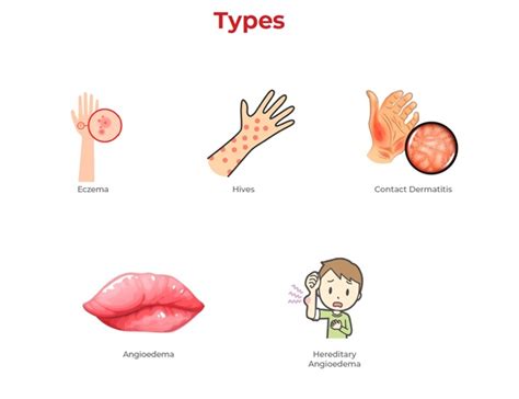 Angioedema Causes Symptoms Diagnosis And Treatment