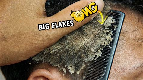 Picking Big Dandruff Flakes Out Of Hair 469 Youtube