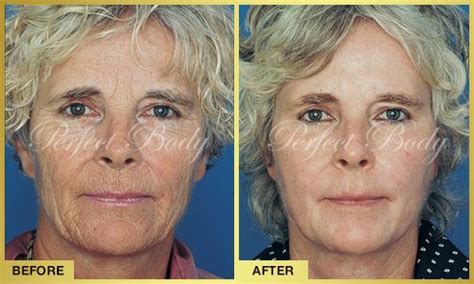 at perfect body laser we offer the newest and best in non invasive technology to provide