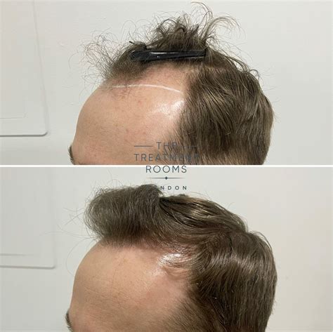 FUE Hair Transplant Result 1936 Grafts Treatment Rooms London