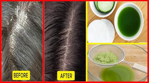How To Cure Dandruff Fast Naturally At Home Get Rid Of Dandruff