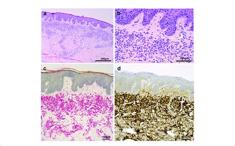 A Skin Biopsy With Lichenoid Leukaemic Infiltration In The Upper