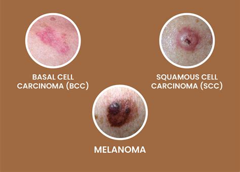Skin Cancer Types Basal Cell Carcinoma