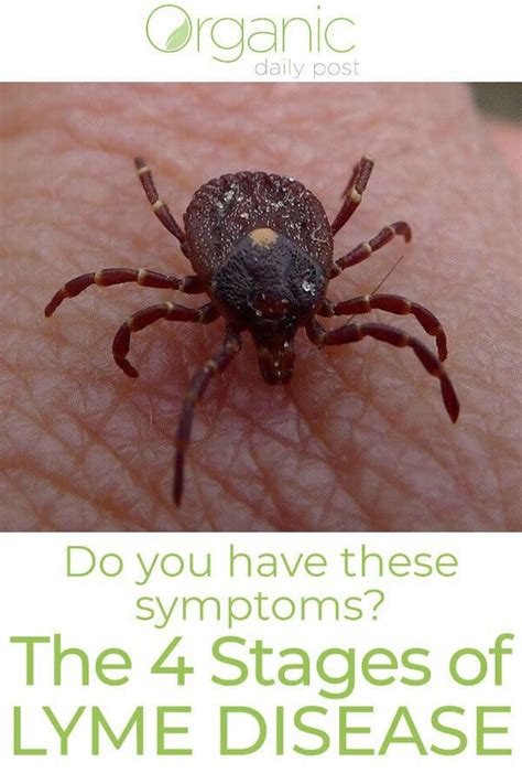 The Four Stages Of Lyme Disease