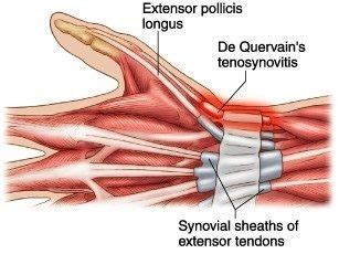 De Quervain S Tenosynovitis Anatomy
