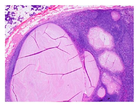 Low Magnification Of The Intraparotid Lymph Node Harboring A Cystic