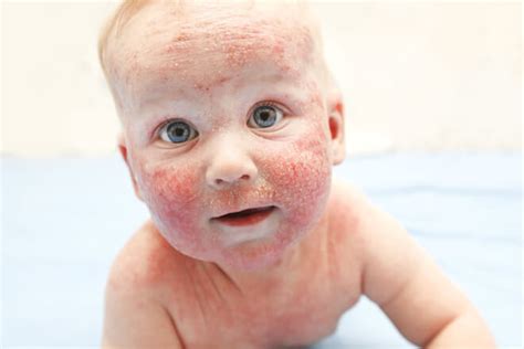 Atopijski Dermatitis Kod Beba I Djece Zdravlje Djece Kreni Zdravo