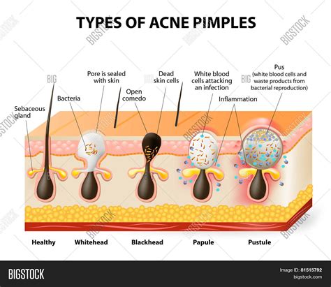 Types Acne Pimples Vector And Photo Free Trial Bigstock