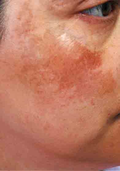 What Causes Skin Pigmentation And Can It Be Treated Myskyn