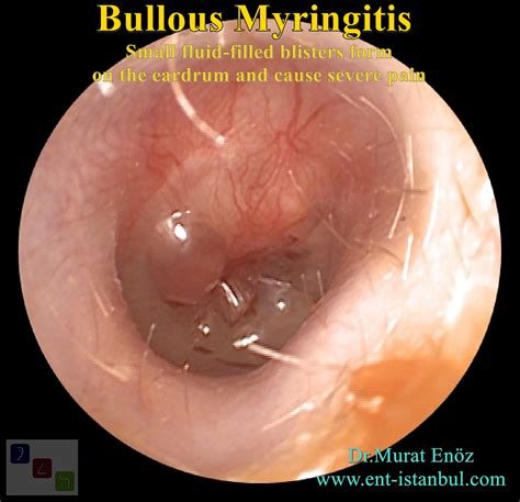 A Painful Type Of Eardrum Inflammation Bullous Myringitis