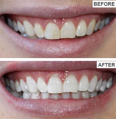 Teeth Whitening Before And After Pictures Gorgeous Smiles
