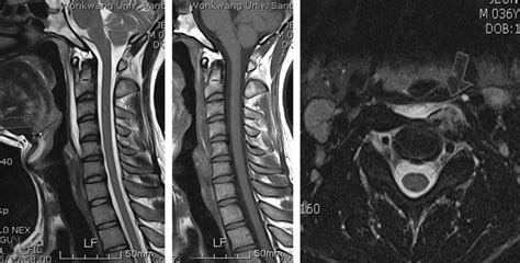 Mri Of Cervical Spine A Sagittal T Weighted Images Show A